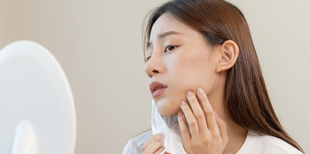 痘痘藥品百百種怎麼用 外用 口服治療原理一次看懂