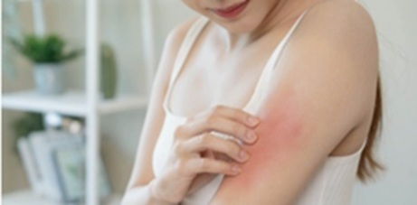 濕疹用藥正確擦 止癢不傷膚