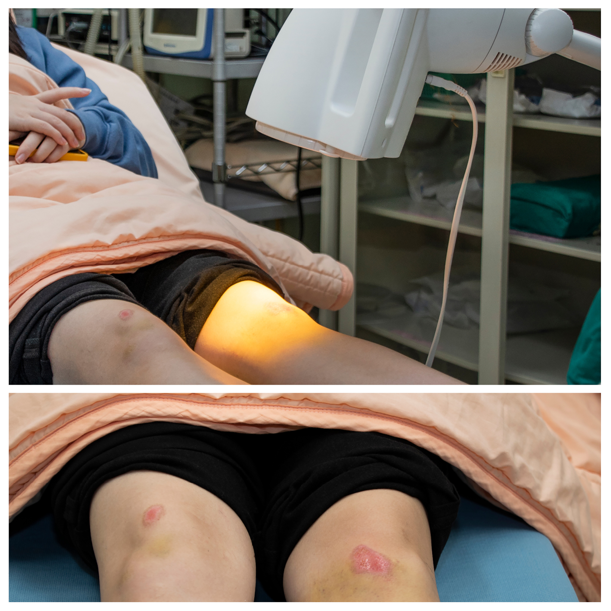 患者接受光療修護傷口，圖中左側傷口為先前接受過光療的傷口，癒合情況良好。