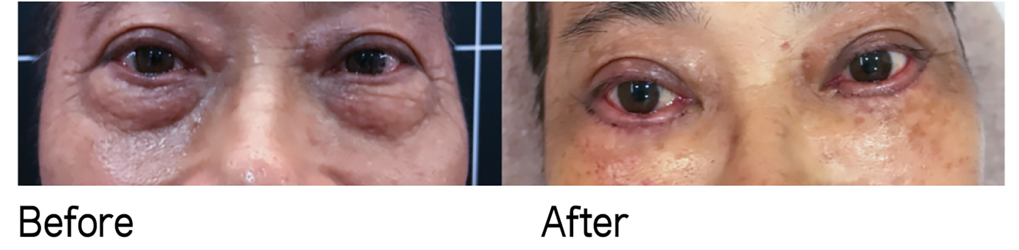 「無痕內開眼袋手術」結合「修皮手術」案例，可見臉上傷口並不明顯。 