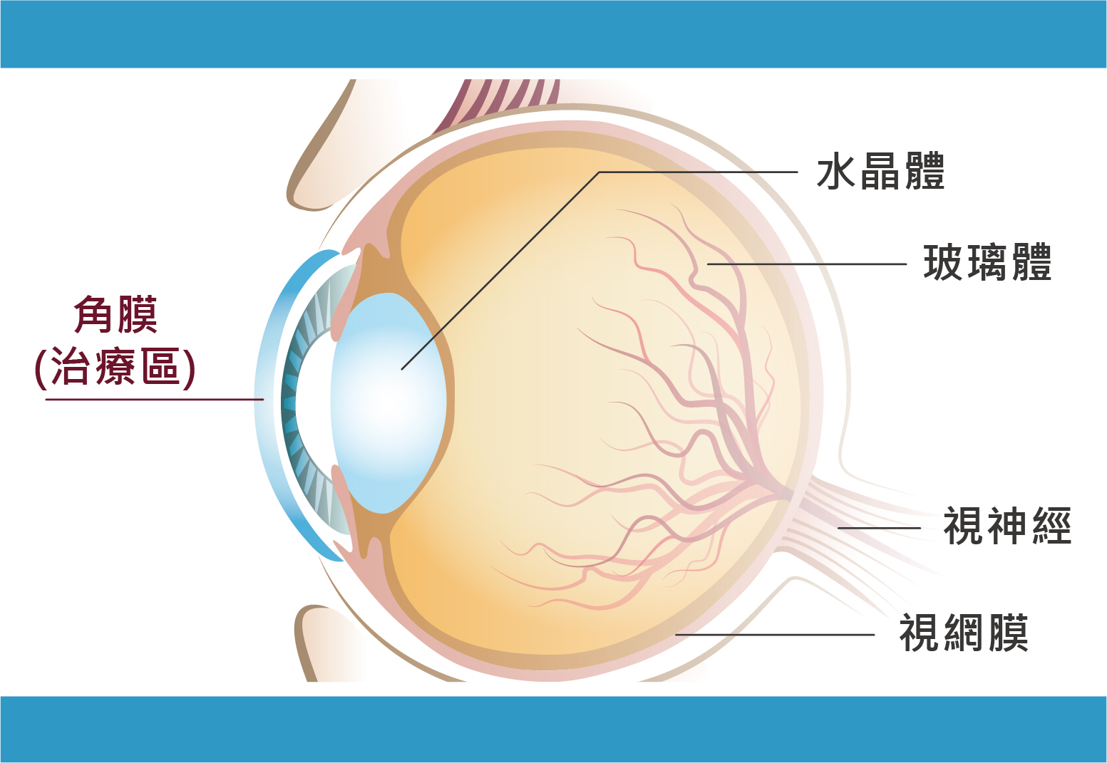 減少近視度數的方式是改變角膜的厚度。