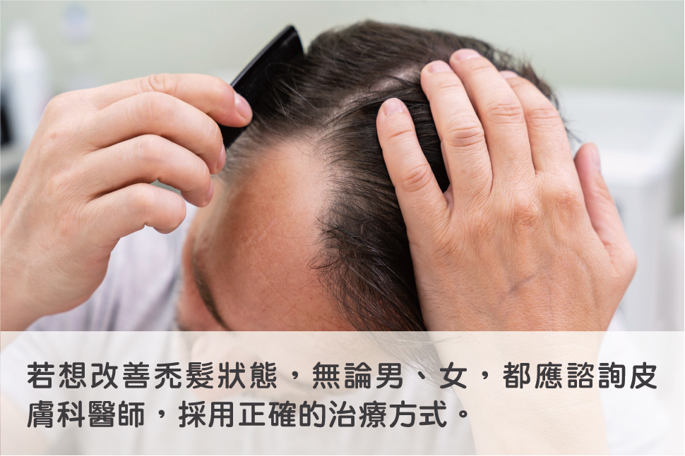 改善禿髮應採正確治療方式