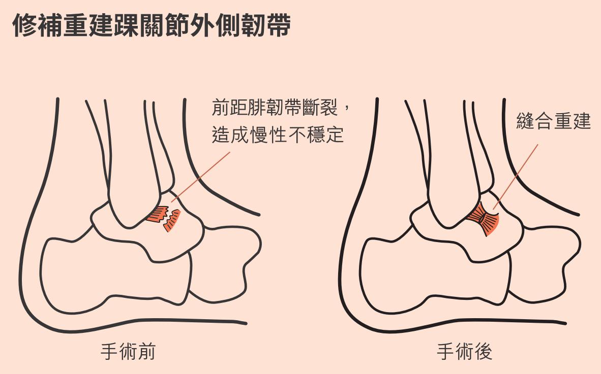 圖片提供：《自己的腳痛自己救》／時報出版